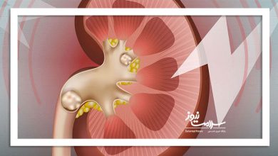 رواج شایعات پیرامون درمان سنگ کلیه