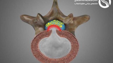 دیسک کمر چیست - دکتر محمد رضا شاه محمدی