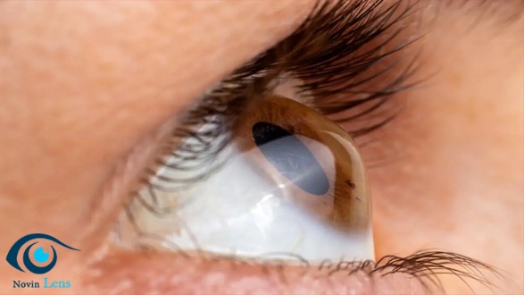 با لنز نوع اسکلرال بیماری های قرنیهای را درمان کنید