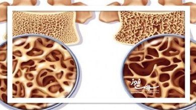 بیماری خاموشی که استخوان‌ها را بی‌صدا می‌شکند: پوکی استخوان و روش‌های پیشگیری