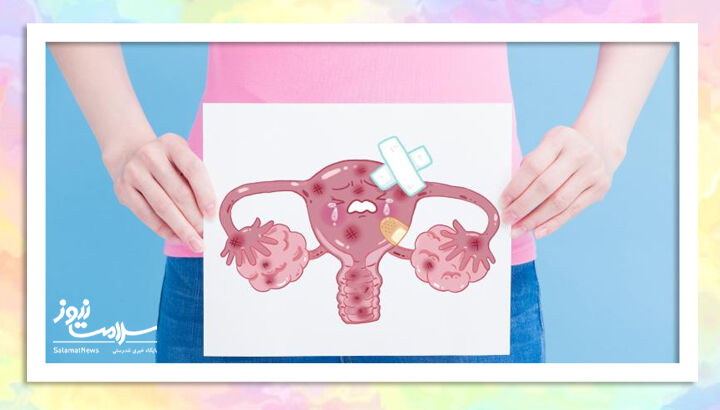 نفخ مداوم می‌تواند نشانه‌ای از سرطان تخمدان باشد