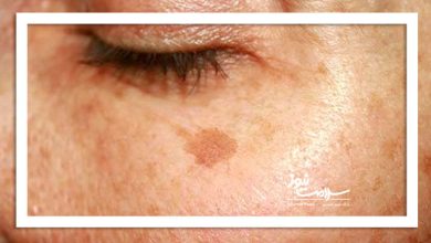 چرا تشخیص لک پوستی اهمیت دارد؟