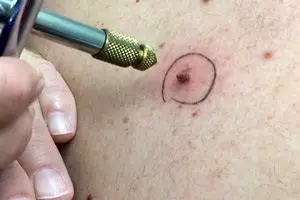 ابتلا به زگیل تناسلی به 17 سال رسید/ تصمیم گیری آموزش و پرروش و وزارت بهداشت برای واکسن گارداسیل دانش آموزان روی هواست/ نوجوانان در معرض خطر خاموش!