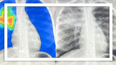 موارد ابتلا به سل در جهان به بالاترین سطح تاریخی رسید؛ ۸.۳ میلیون نفر مبتلا در ۲۰۲۴"