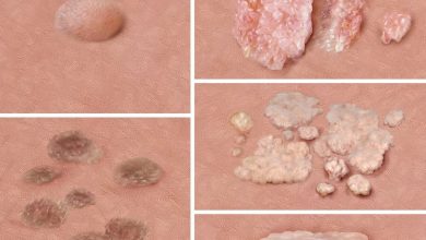 ویروس زگیل تناسلی (HPV) از پیشگیری تا کاهش عوارض