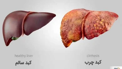 کبد چرب و بسیاری بیماری‌های گوارشی اغلب بی‌علامت‌اند