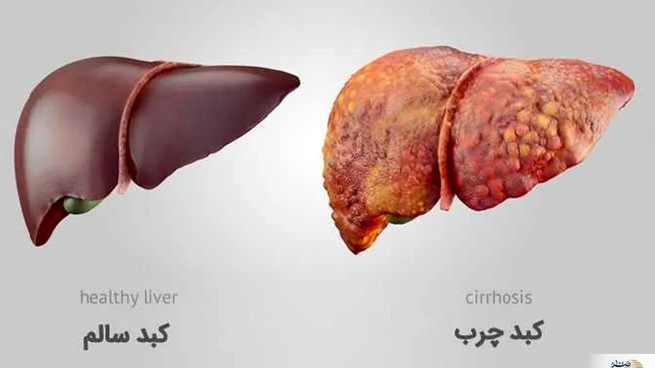 کبد چرب و بسیاری بیماری‌های گوارشی اغلب بی‌علامت‌اند