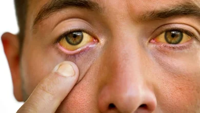 ابتلا به هپاتیت B در جهان کاهش یافته است