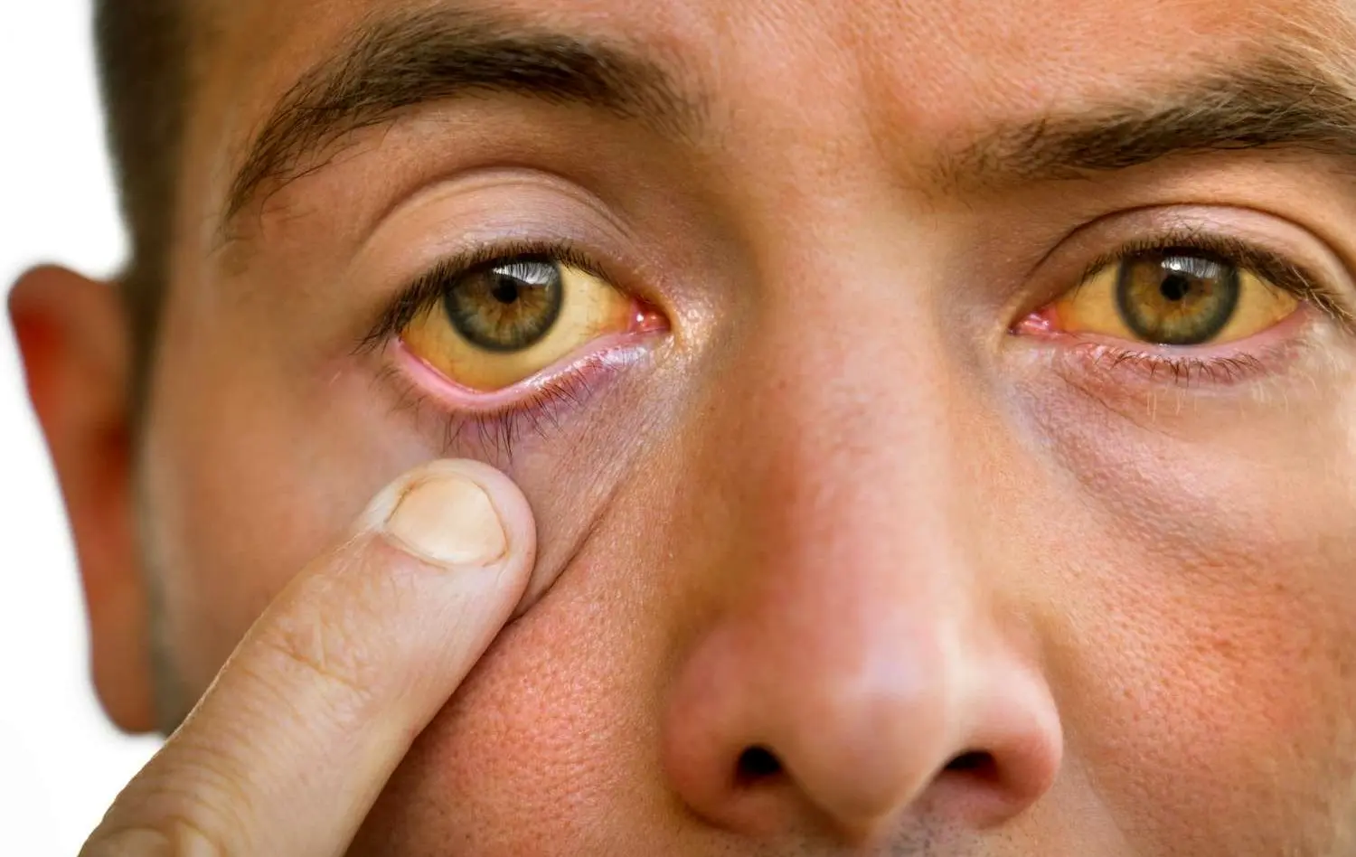 ابتلا به هپاتیت B در جهان کاهش یافته است