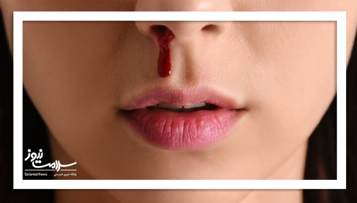 چگونه خون دماغ را بند بیاوریم؟